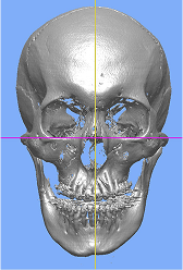 재구성 3D-CT (두개골)